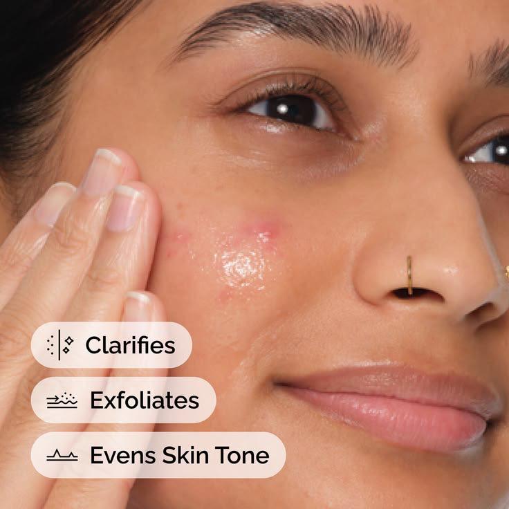 Anti Acne Facial